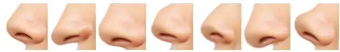 nose tip rhinoplasty