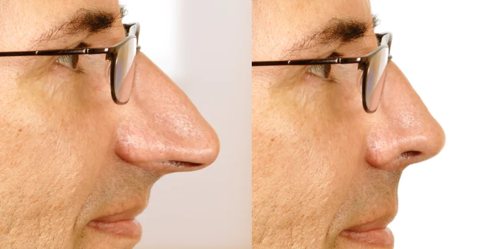 piezoelectric ultrasonic rhinoplasty (4)