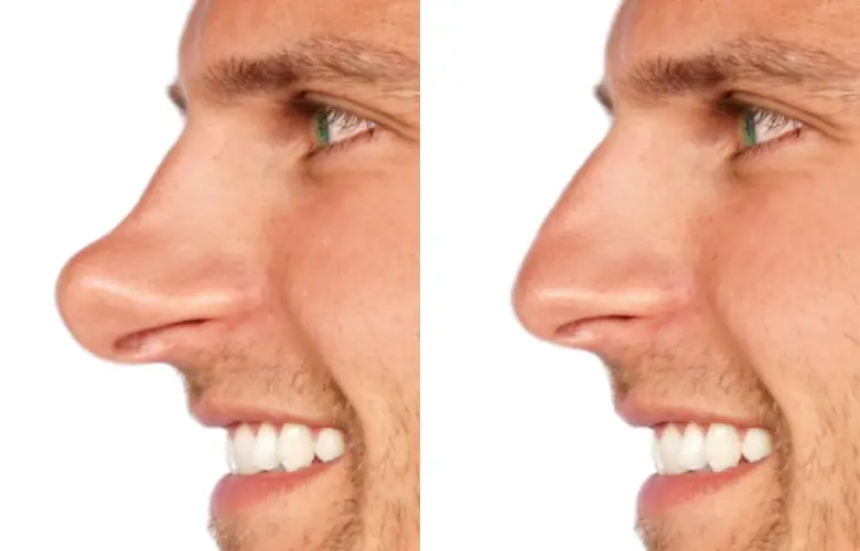 pointe du nez bombé bosse rhinoplastie