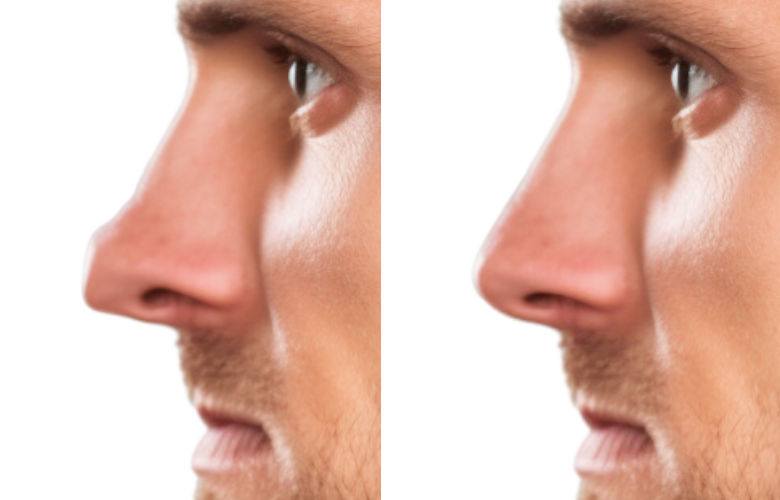 pointe du nez carré carmard rhinoplastie