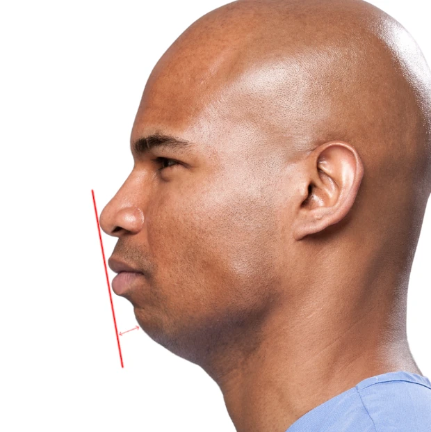 Receding chin calculation