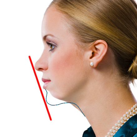 Receding Jaw