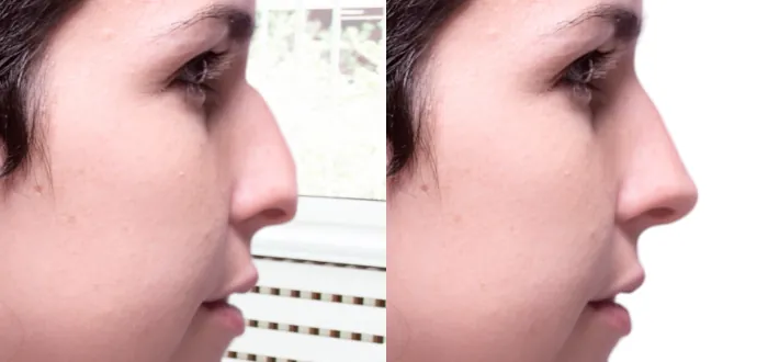 rhinoplasty hyaluronic a