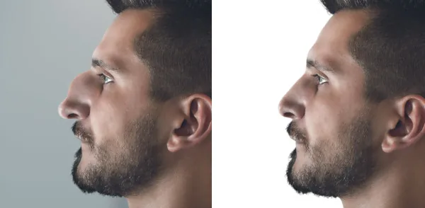 rhinoplasty nose surgery before-after