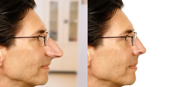 Before and after photos of long nose