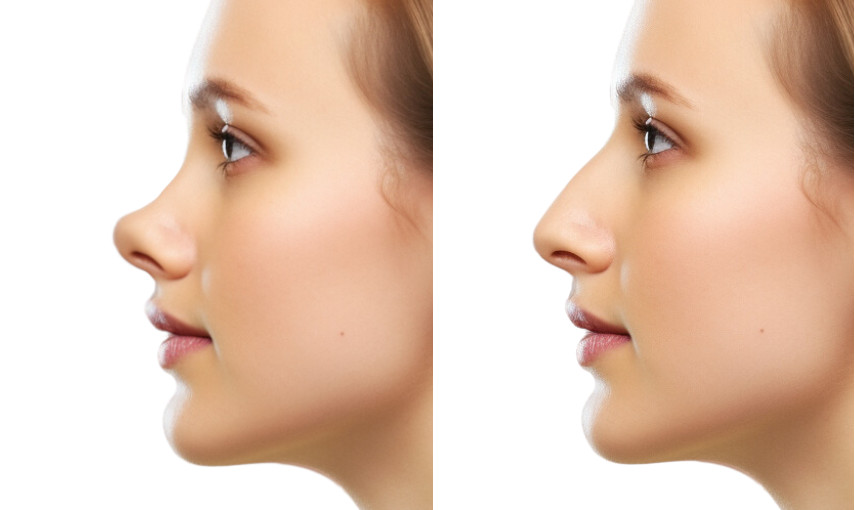 Before and after rhinoplasty photo