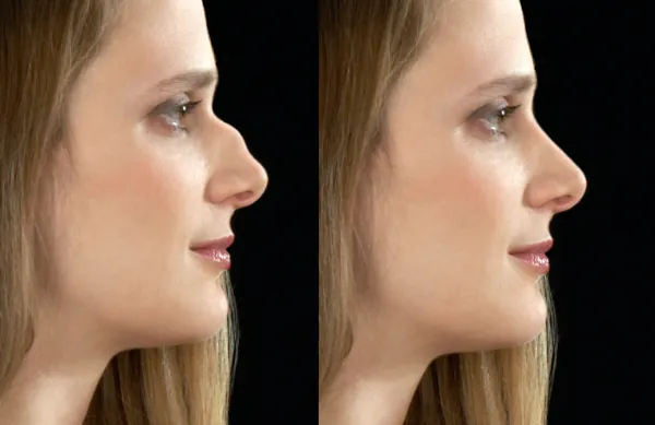 before and after photo of Greek nose