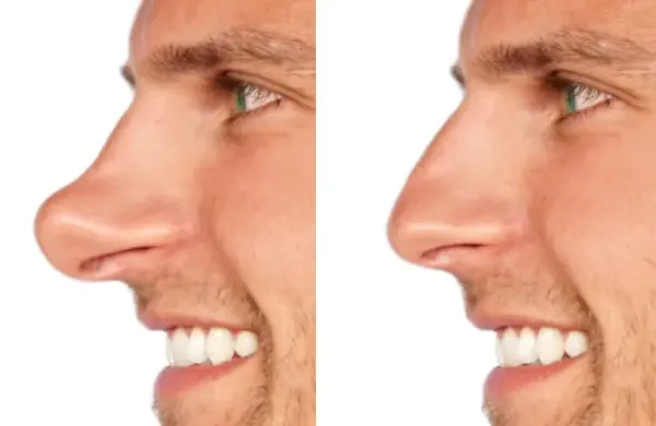 before and after photo of bump on the tip of the nose