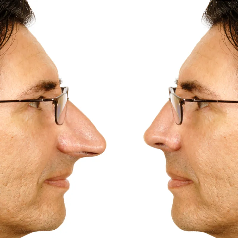 big long nose rhinoplasty
