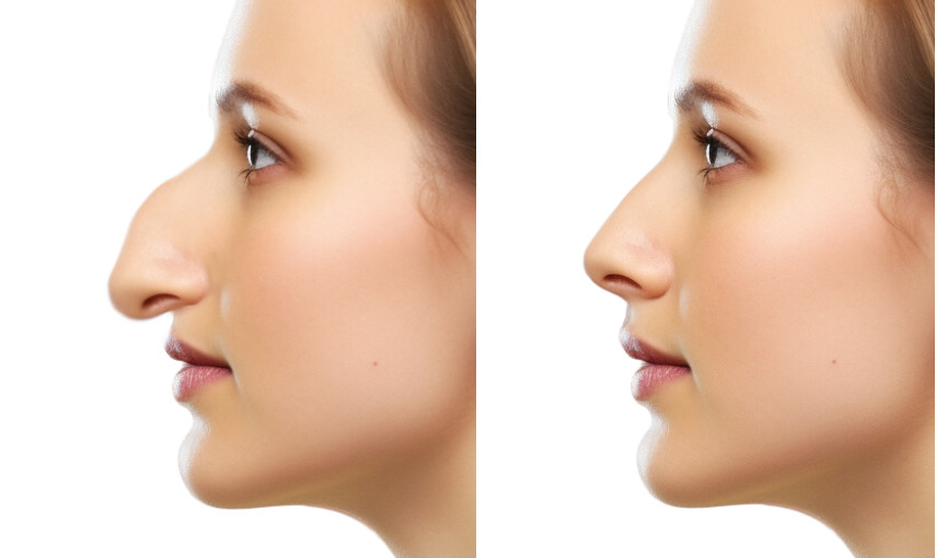 drooping nose