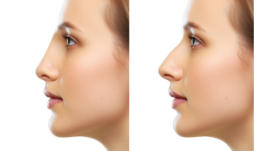 forecast BEFORE AFTER straight nose