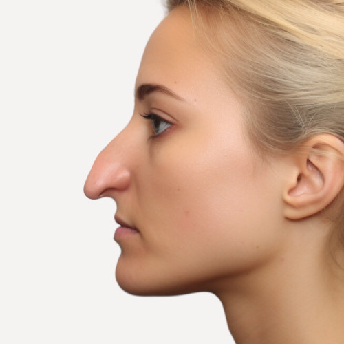 hooked nose woman rhinoplasty (1)