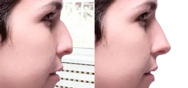 hyaluronic acid injections before and after