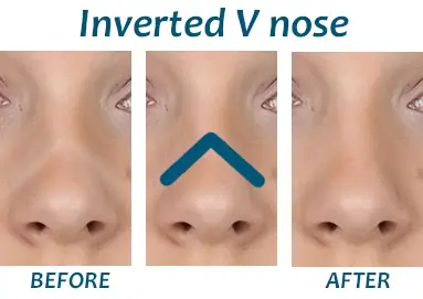 v inverted nose rhinoplasty (1)