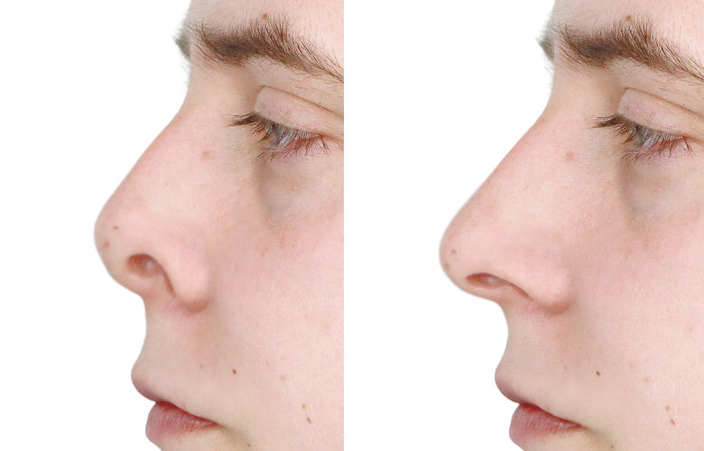 pig nose rhinoplasty
