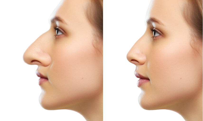 rhinoplasty BEFORE AFTER big nose