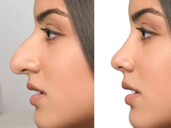 rhinoplasty before and after Tunisia