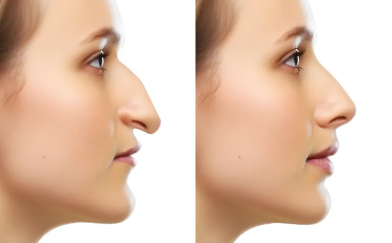 rhinoplasty before and after hooked nose