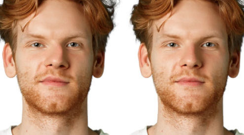 rhinoplasty crooked nose man