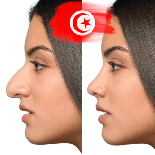 rhinoplasty in Tunisia