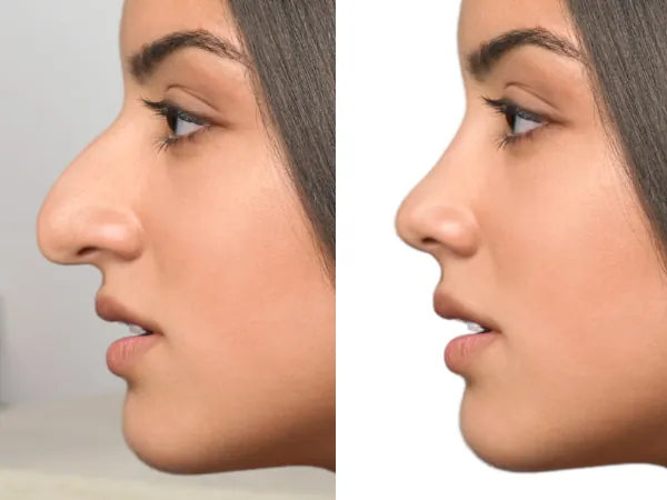 rhinoplasty in Tunisia