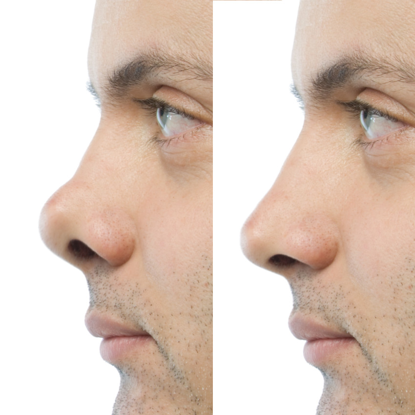 secondary rhinoplasty