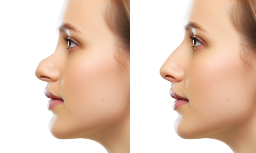 simuation before after surgery