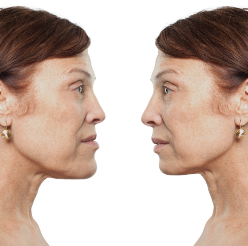 surgery before after simulation-result