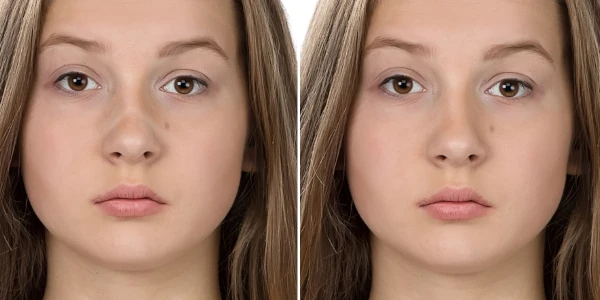 v inverted nose rhinoplasty