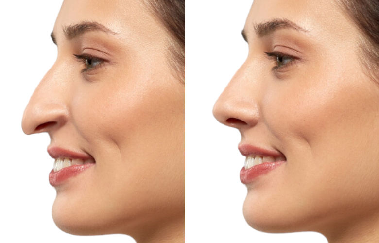 witch nose