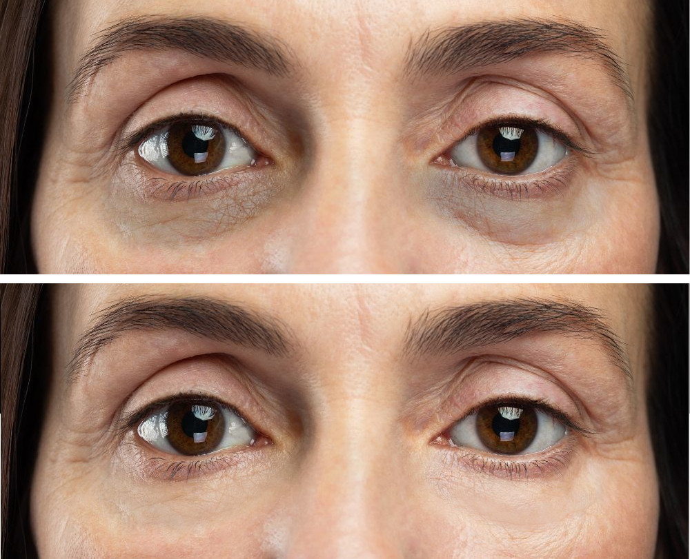 dark circles bags under the eyes