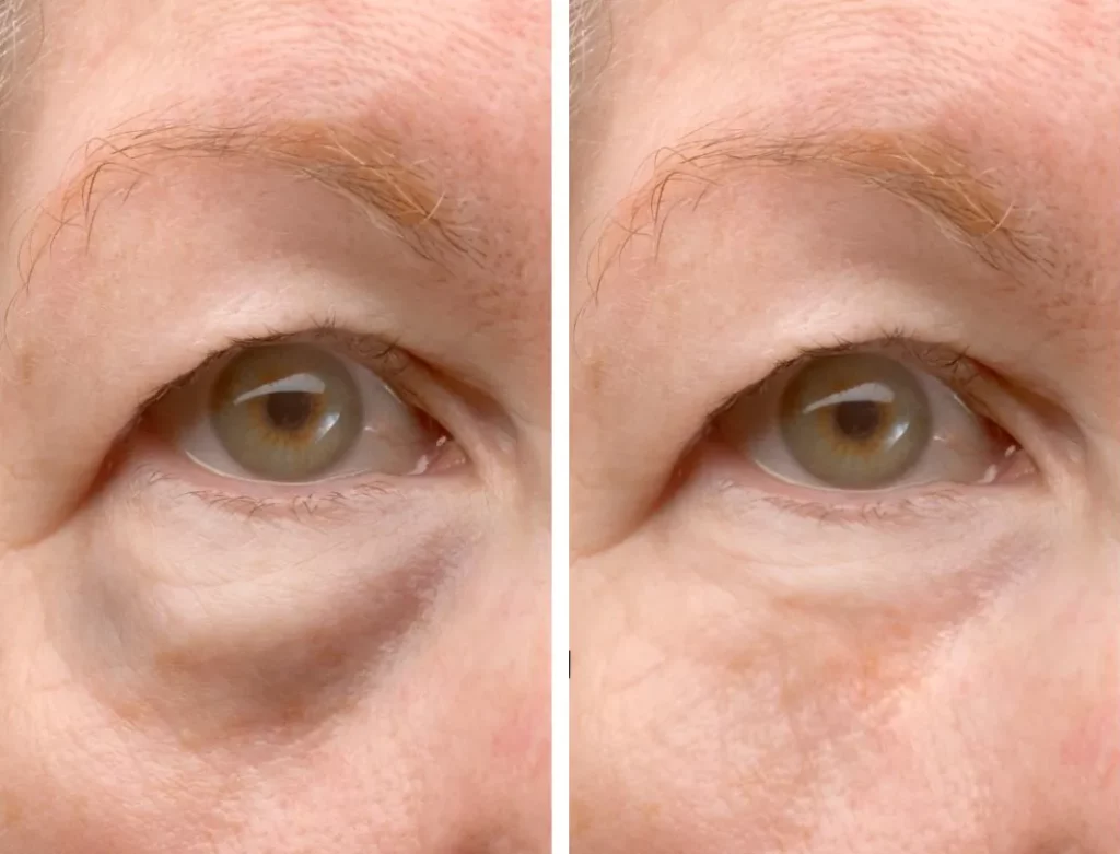 dark circles bags under the eyes (3)