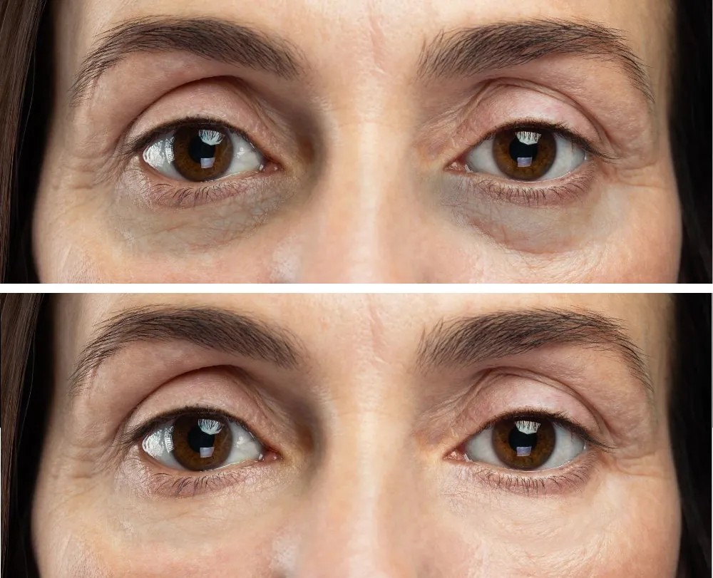 dark circles bags under the eyes (4)