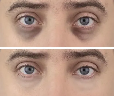 dark circles bags under the eyes (5)