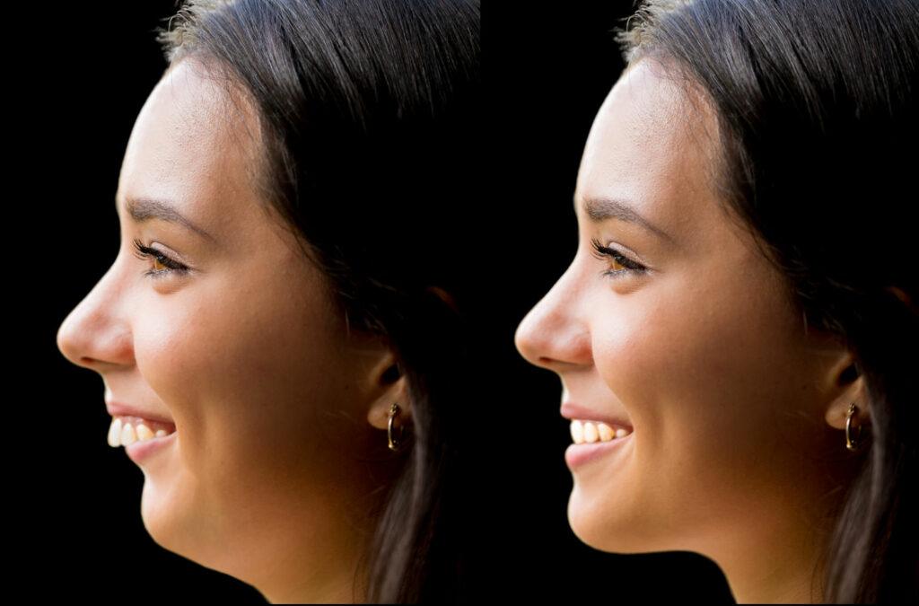 Class II dentition, orthodontics, chin receding backwards (4)