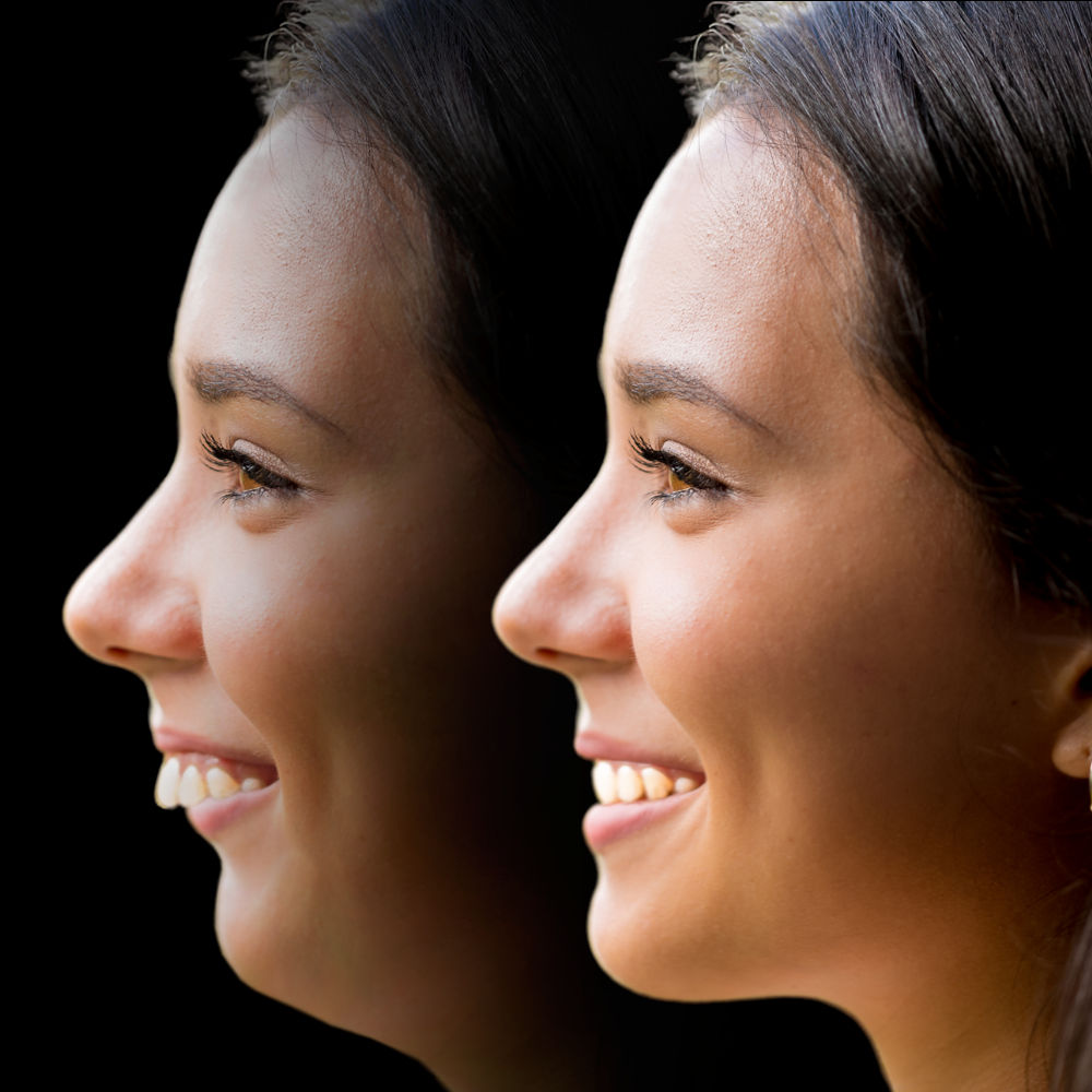 Class II dentition, orthodontics, chin receding backwards