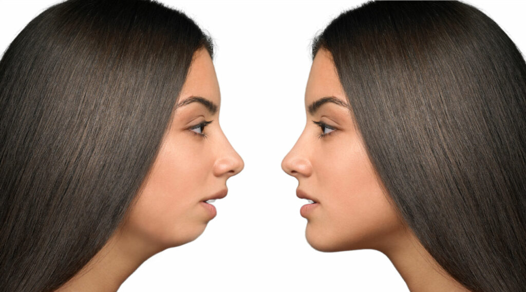 non-existent chin, all flat, leaking class II