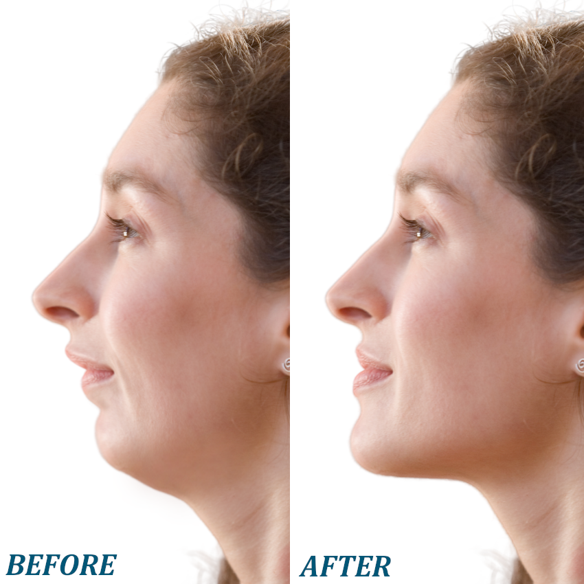 receding jaw class II