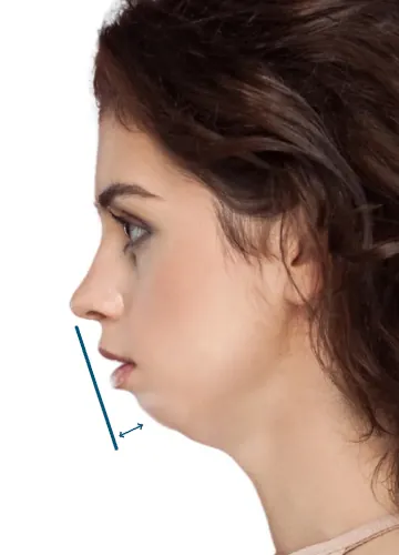 How to know if you have a receding chin