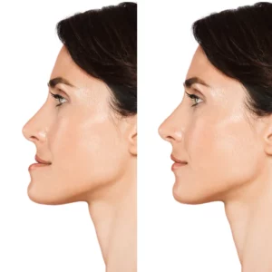 chin forward