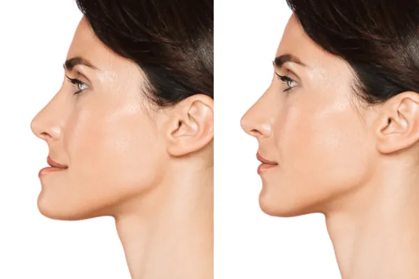 chin forward before after