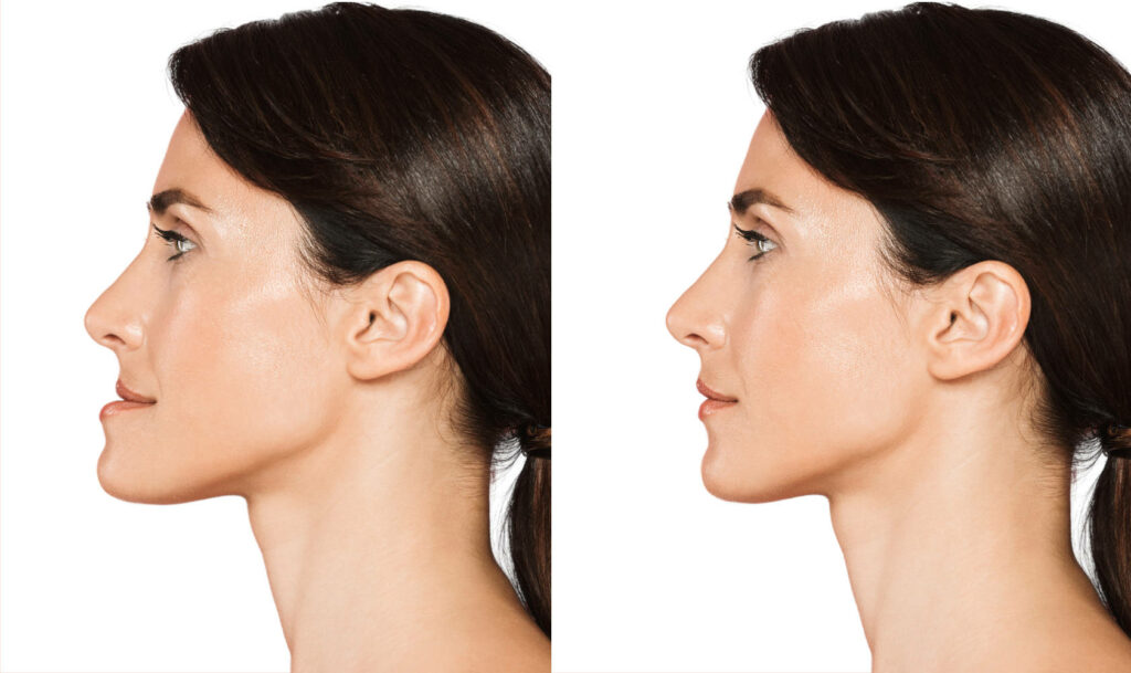 chin forward woman