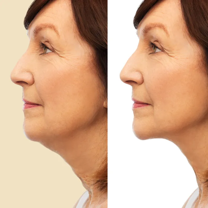 neck lift before after