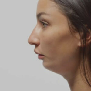 woman with a receding chin
