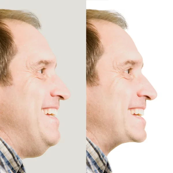 neck lift