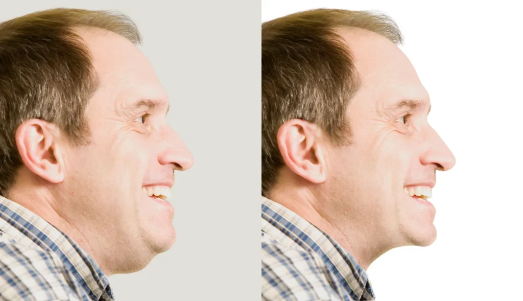neck lift men