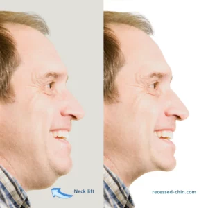 neck lift recessed-chin.com