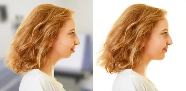chin surgery genioplasty chin-wing