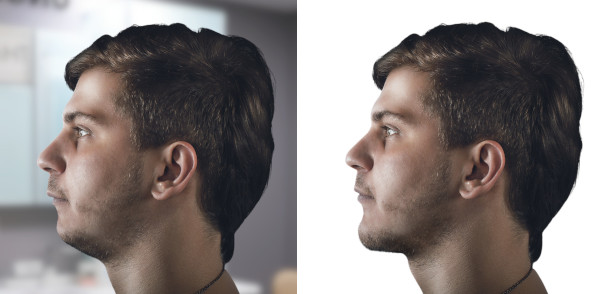 class II skeletal surgery before after