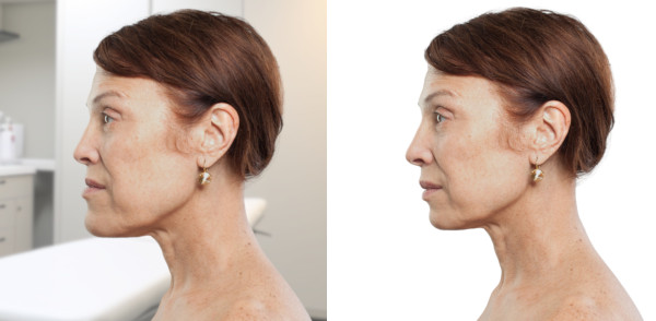 class-III-mandibular-setback-surgery-skeletal-before-after-600r
